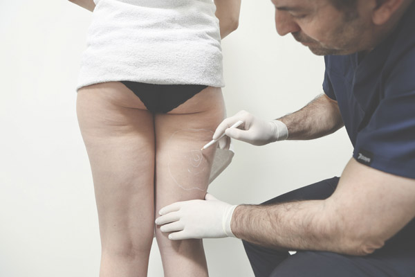 mein-laserzentrum--cellulite--vorbereitung