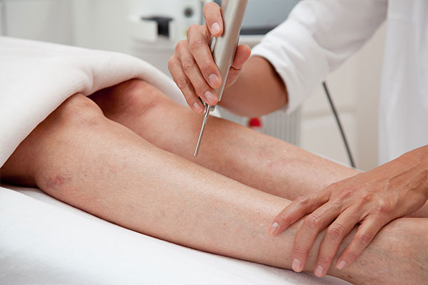 mein-laserzentrum--besenreiser-behandlung